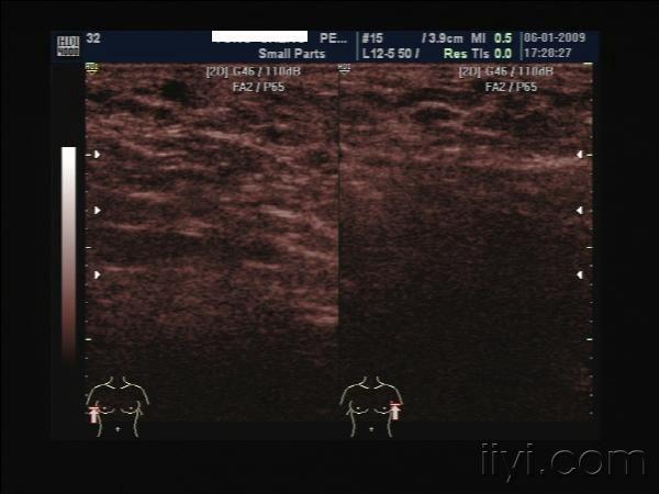 副乳,已手术,有超声图片及病理图文.