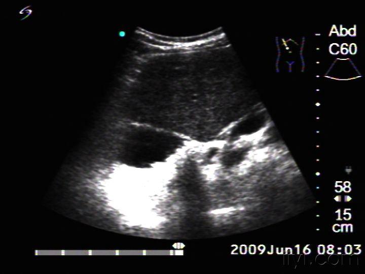 于右腋前线处见胆囊声像,其大小形态正常,壁厚约3mm,腔内见多枚强光点
