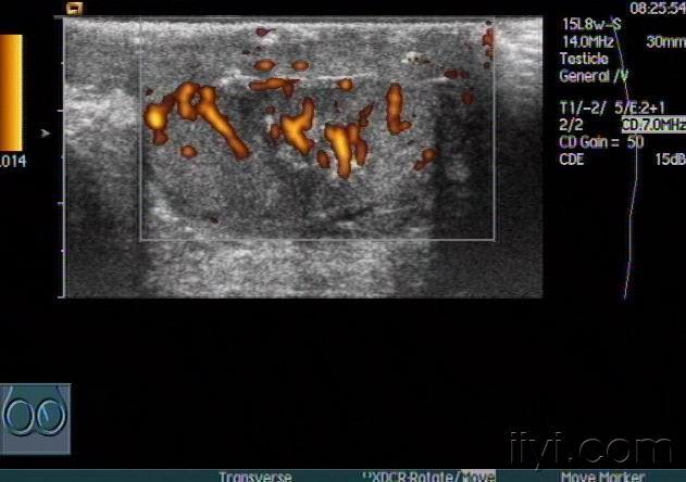 睾丸扭转及术后随访声像图 - 超声医学讨论版 - 爱爱