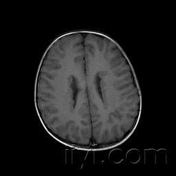典型病例-脑灰质异位症