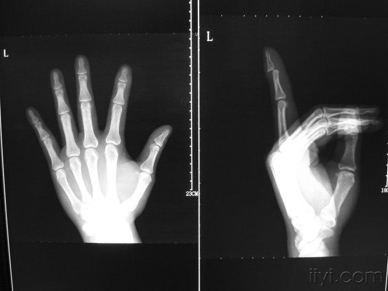 辅助检查:左食指远节指间关节脱位  掌侧小骨片撕脱  初步诊断:左