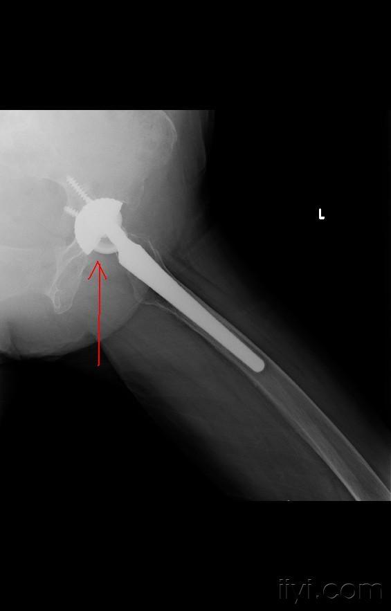 今年2月份起感左侧髋关节不适,走路时偶尔出现嘎啦嘎啦的响声,并有