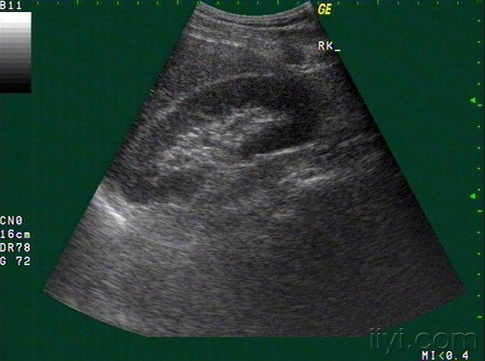 19:42:36今天来一患者,左侧腰痛前来就诊,按道理囊肿在超声上是可以