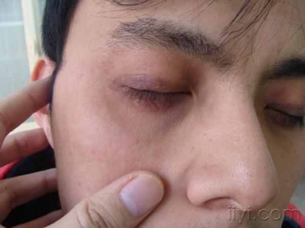病例诊断——湿疹或神经性皮炎?