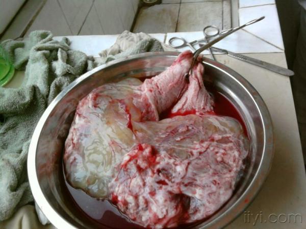 患者为35岁女性,自觉腹部增大并发现包块5个月.
