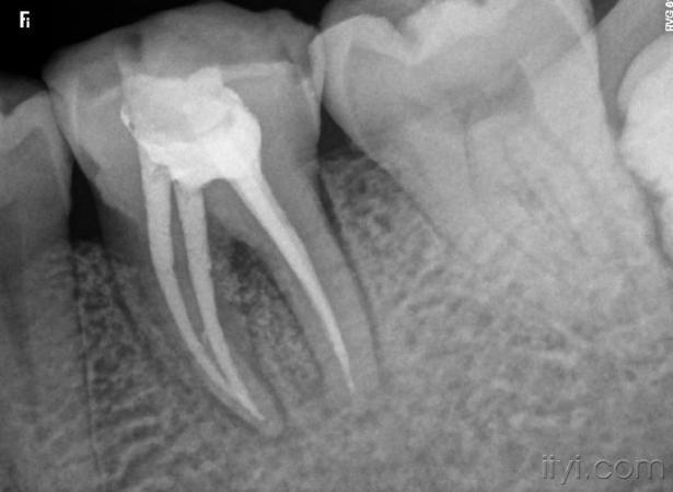 到一定的别扭,仔细探查,发现根管在下端是分叉的,最后仔细预备后根充