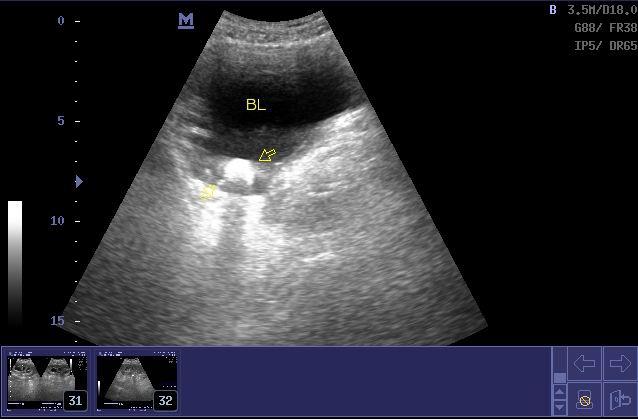 膀胱憩室,肿块,结石等 超声医学讨论版 爱爱医医学论坛 爱爱医