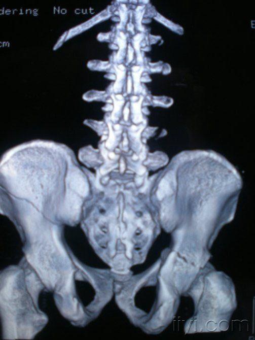 诊断为:第七颈椎横突骨折,锁骨骨折,1234腰椎横突骨折,右髋臼骨折,左