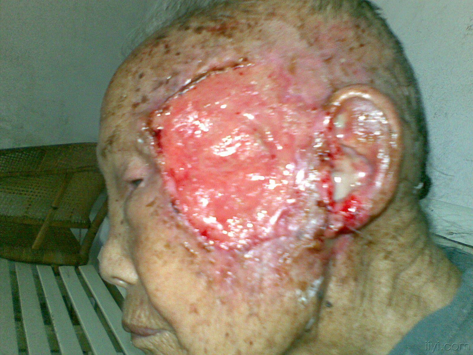 2009-6】左面部 皮肤癌 合并蝇蛆感染
