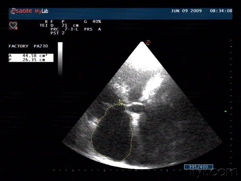 楼主晓辉20062009-07-31 16:07:59老年男性,73岁,心脏超声如下:左室长