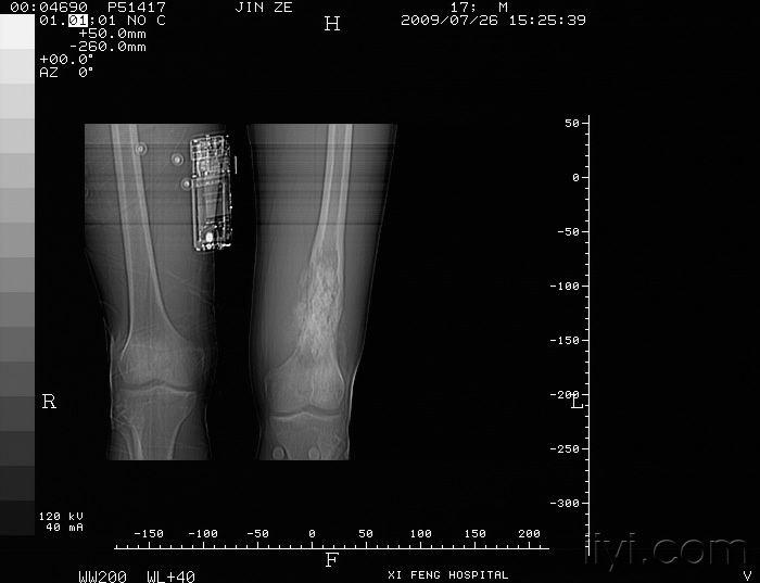 m,17岁,大腿痛1月 该患者ct片已发,请大家继速讨论