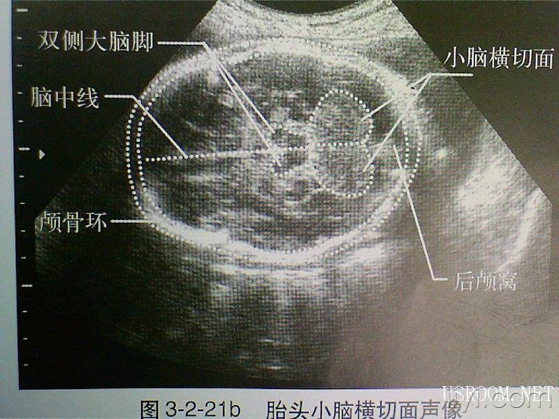 中孕胎儿超声检查规范