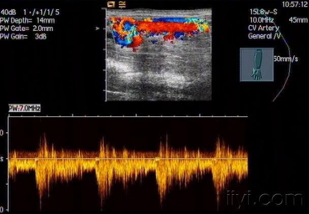 超声诊断动静脉瘘两例.----zengerya