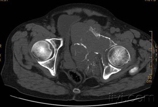 [读片]骨盆病变/dr,ct及mr/病理已公布/20090811