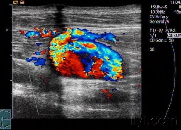 超声诊断动静脉瘘两例-zengerya