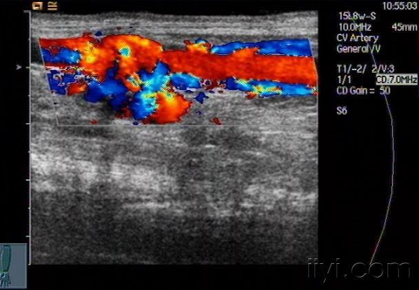 超声诊断动静脉瘘两例.----zengerya