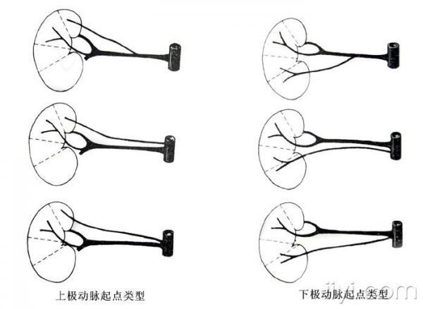 肾动脉变异(副肾动脉)