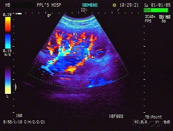肾动脉变异(副肾动脉) - 超声医学讨论版 - 爱爱医