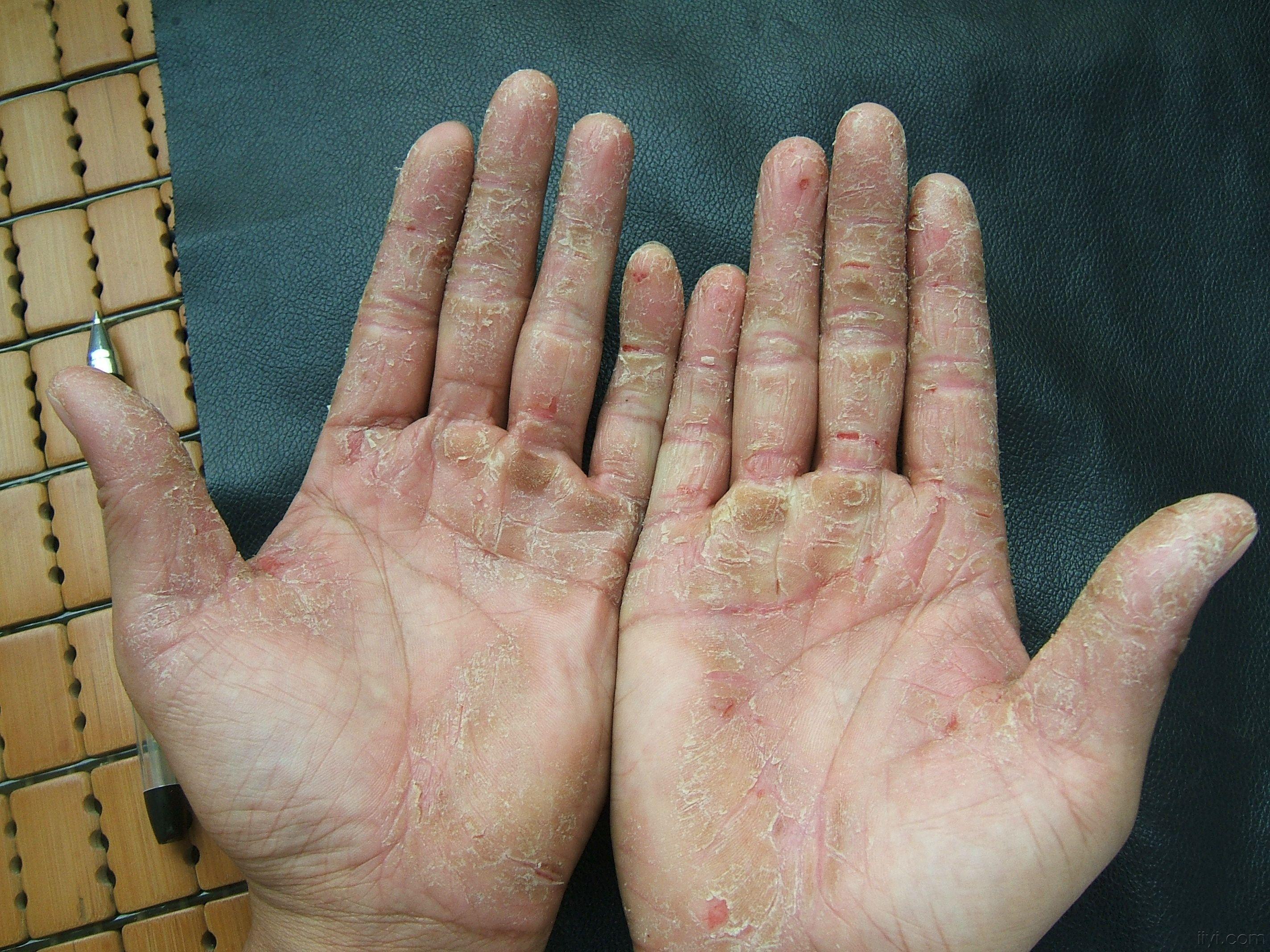 手部干糙 蜕皮,伴皲裂.痒痛.2年. - 皮肤及性传播疾病