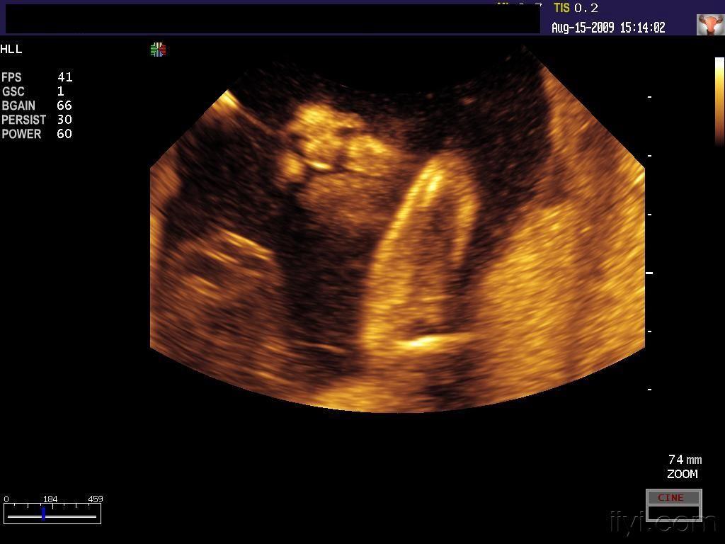 楼主doctorwangzi2009-08-23 21:34:09孕19周,胎儿上唇部可见双侧唇裂