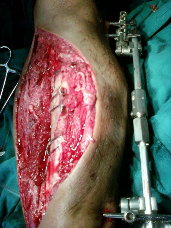左腿胫腓骨下段开放性骨折 医生说用石膏一个星期后消肿手术 会有后遗