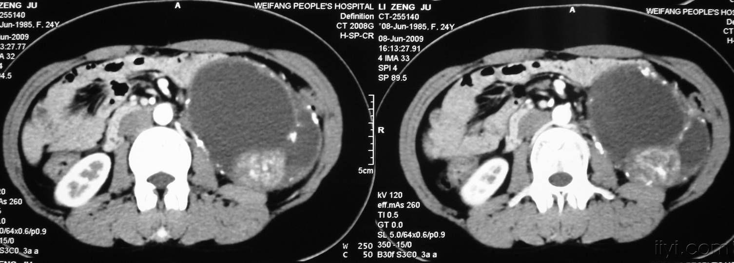 左肾脏囊性病变,已经公布病理-病理为囊性肾癌