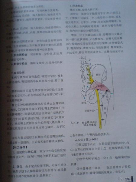 发个梨状肌综合征针刀图片供大家欣赏一下.