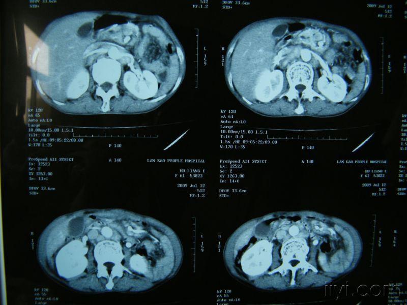 一例食管癌肝转移的ct片