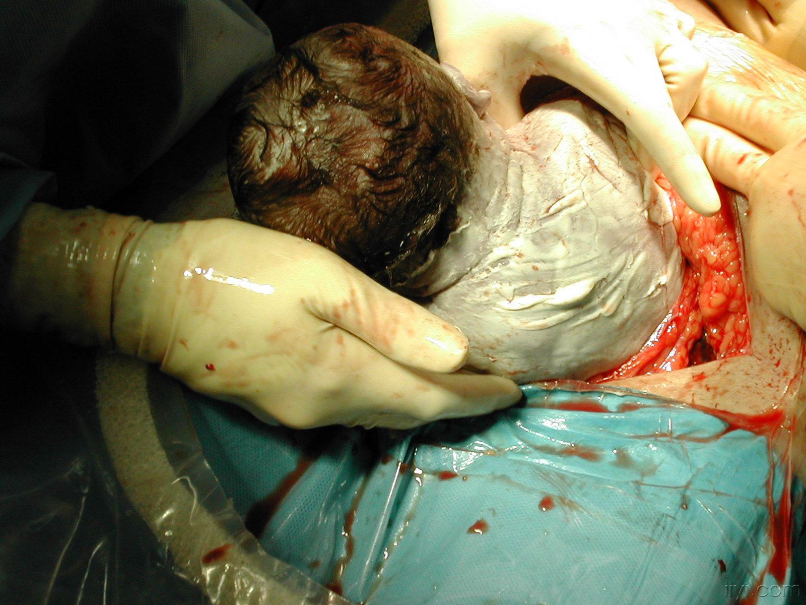 一组高清晰的剖腹产手术照片