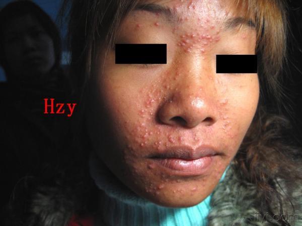 她脸部皮损,因擦皮炎平引起.公布答案:类固醇性痤疮