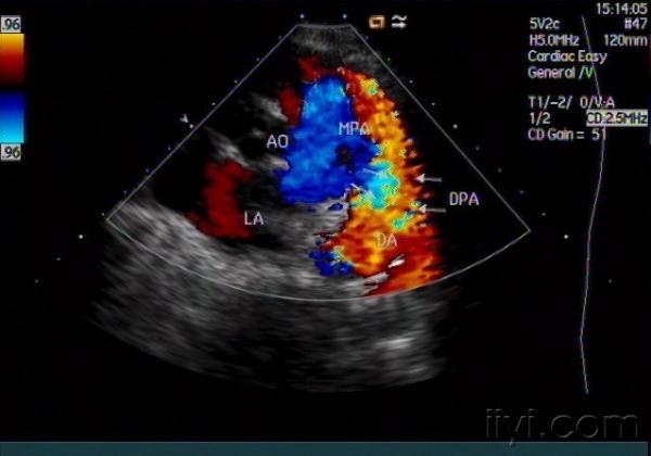 动脉导管未闭声像图——zengerya - 超声医学讨论版 -