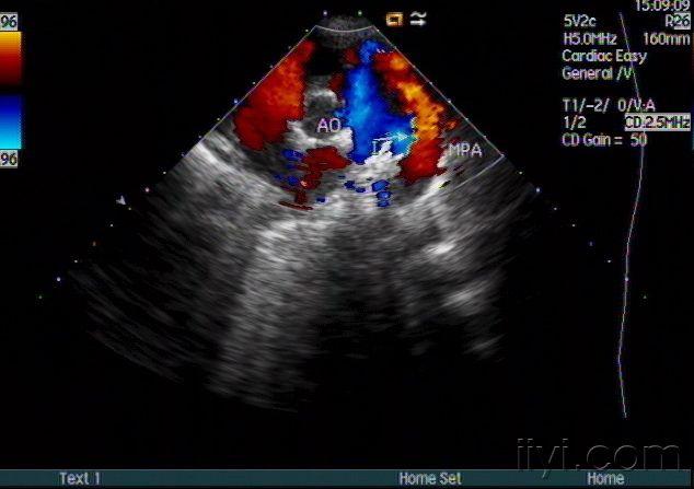 动脉导管未闭声像图——zengerya - 超声医学讨论版