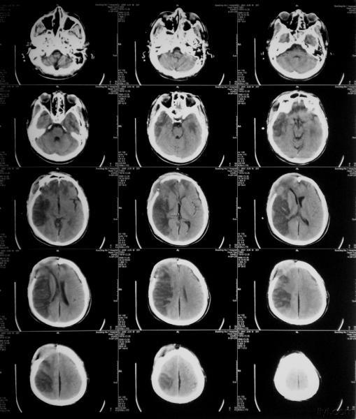 右额叶脑挫伤术后大面积脑梗塞并发脑出血