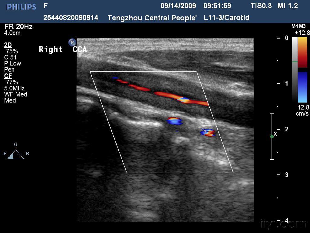 经典超声图片欣赏:大动脉炎所致左侧颈总动脉梗阻