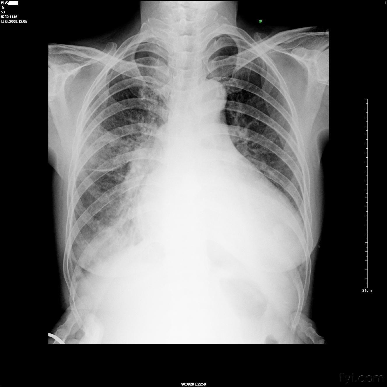 很明显的这个患者从片子上看是:肺淤血,肺水肿,右侧胸腔少量积液可能
