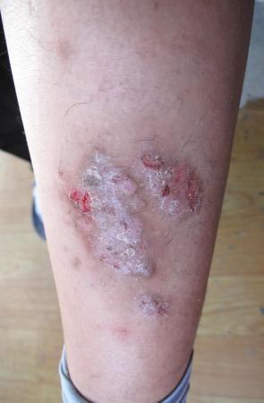 左小腿伸侧皮肤病,发现5年.瘙痒.发作 与饮食有关.