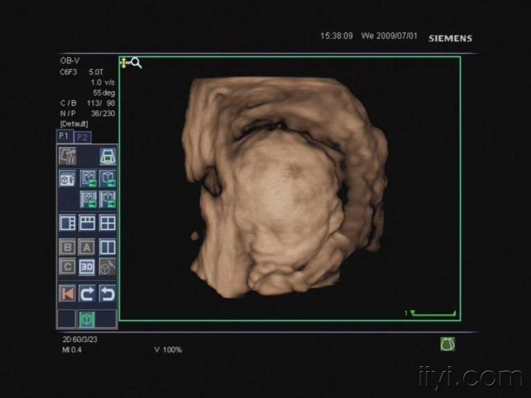 胎儿四维成像图片