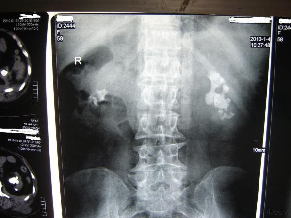双肾铸型结石,慢性肾衰10年,左腰部红肿包块1个月,图.