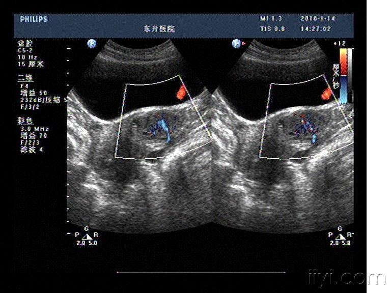 宫颈肌瘤(病理已公布) - 超声医学讨论版 - 爱爱医医学论坛 - 爱爱医