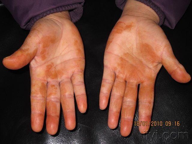 [原创]双手掌褐黄色色素斑-----诊断啥病?