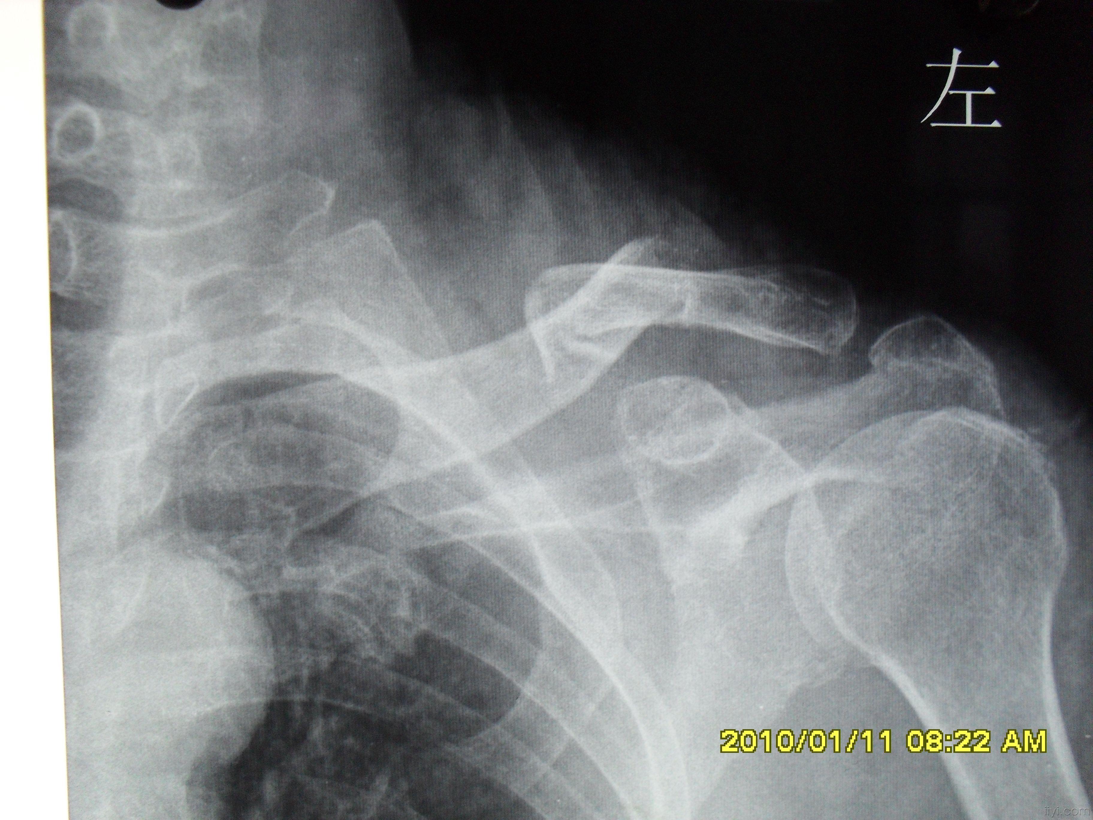 骨质疏松症并锁骨骨折一例