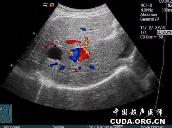门静脉血管瘤 - 超声医学讨论版 - 爱爱医医学论坛-爱爱医医学网