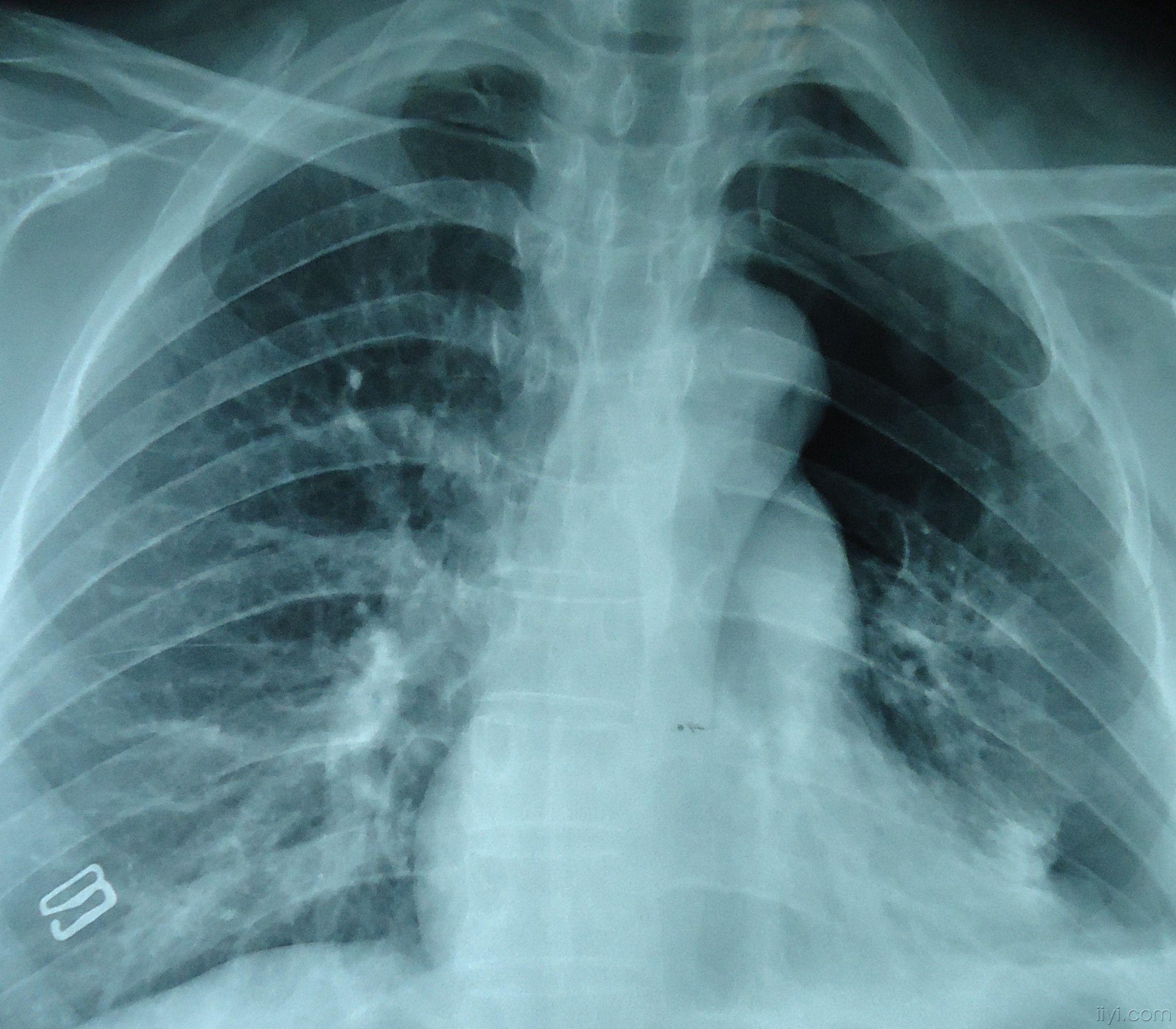 2,左侧血气胸 入院后胸腔闭式引流后拔管再复查胸片及ct仍有左