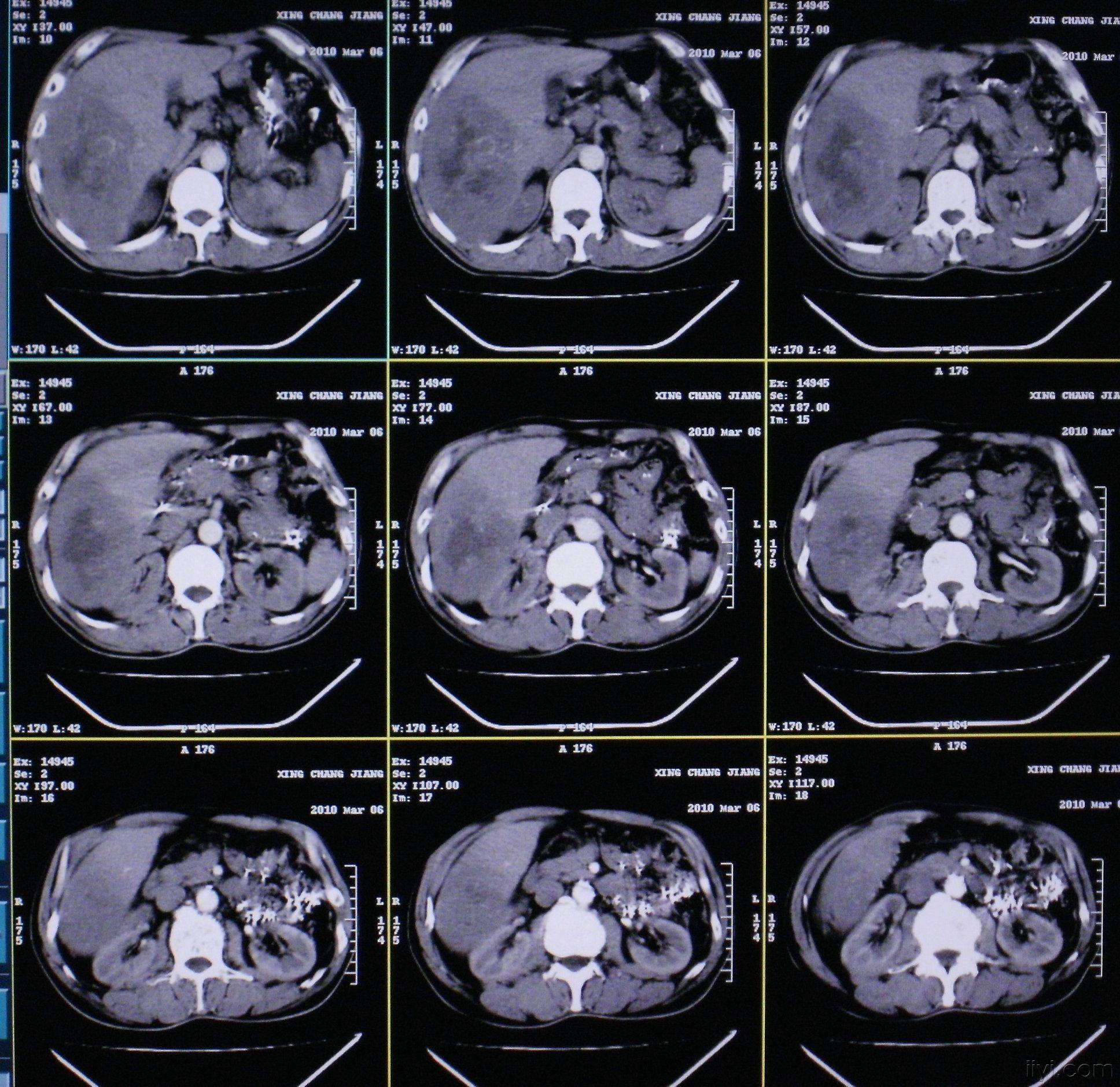 图22-31 经腹腔干的CT矢状断层图像-腹部外科临床解剖学-医学