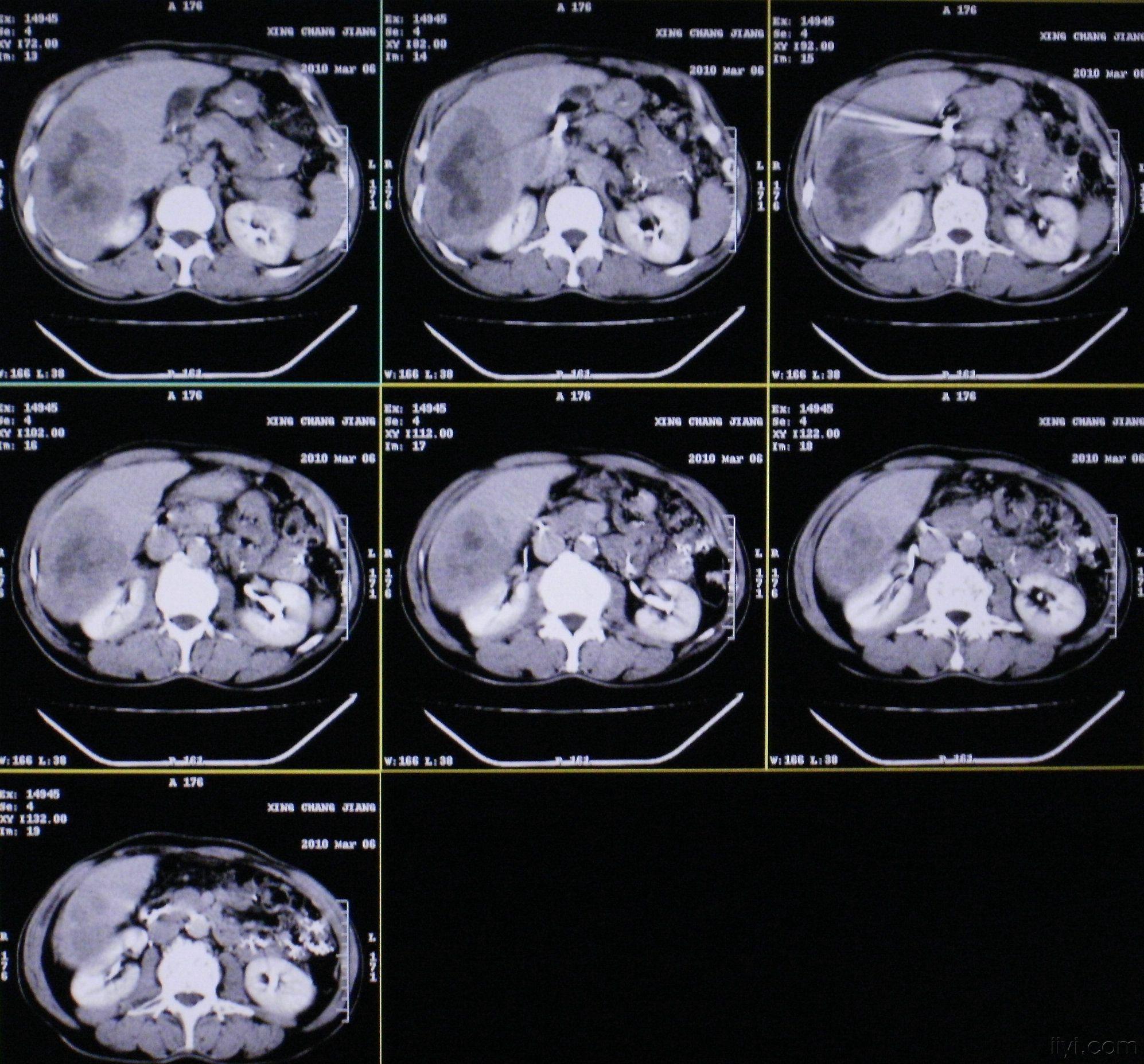 [读片]腹部/ct平扫 增强/病理已公布/20100316