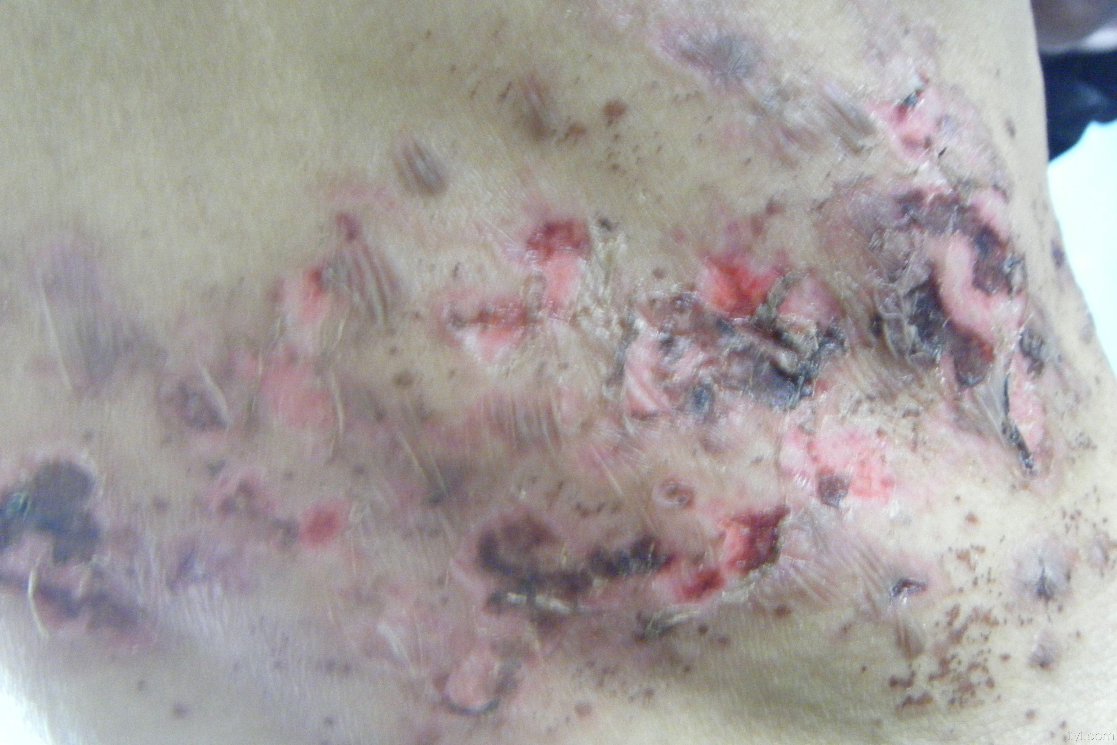 发几张快治愈的带状疱疹的图片(附恢复的照片)