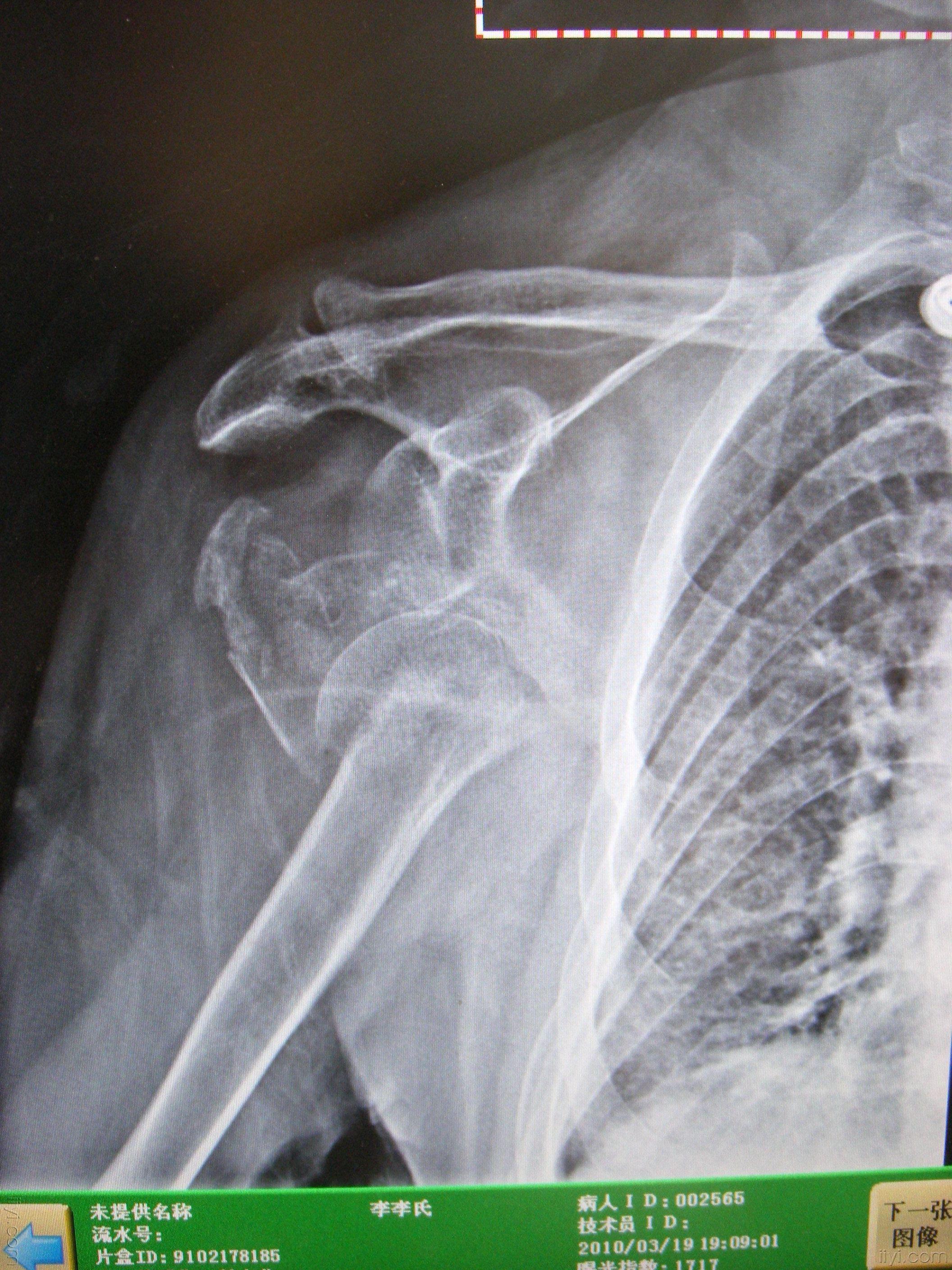 病例14 肩关节脱位-X线读片-医学