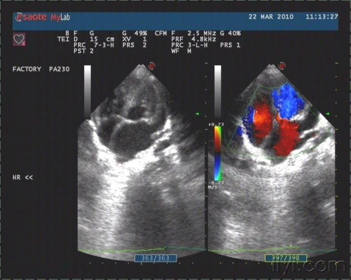 二尖瓣狭窄 - 超声医学讨论版 - 爱爱医医学论坛-爱爱医医学网