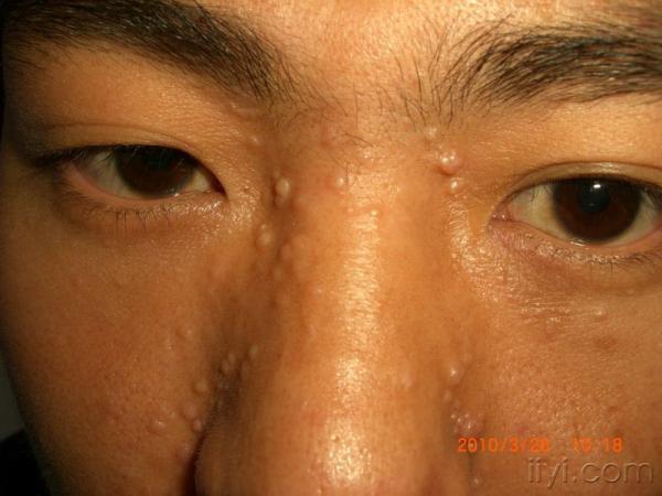 除了传染性软疣还应考虑什么