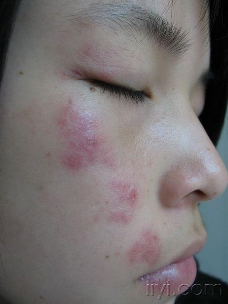 女孩右侧皮疹--带状疱疹